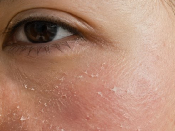 Close-up of a person’s face showing dry, flaky, and irritated skin on the cheek area below the eye. The skin appears red and rough in texture, possibly indicating an imbalance in the skin microbiome.